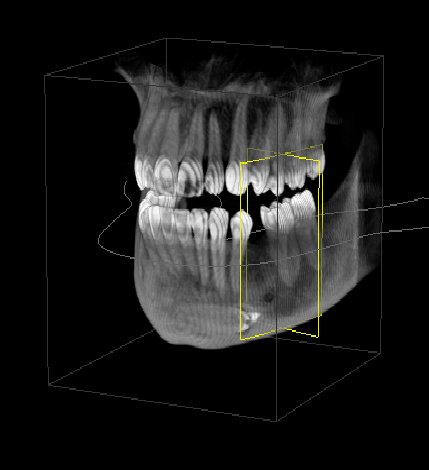Image of a 3D radiographic scan of the jaw.